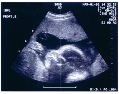 Pregnancy Ultrasound Picture : week 28