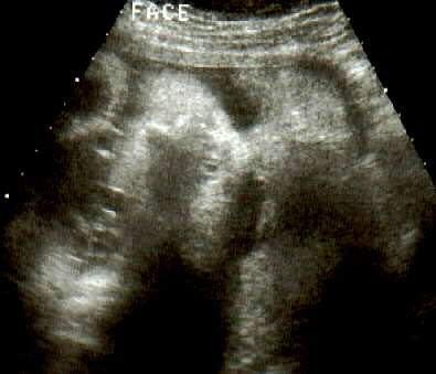 Pregnancy Ultrasound Picture : week 37