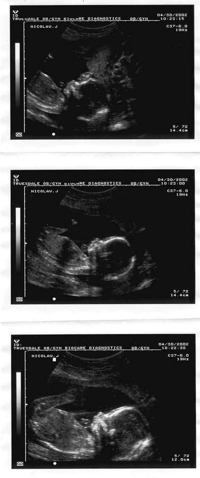 Pregnancy Ultrasound Picture : week 20