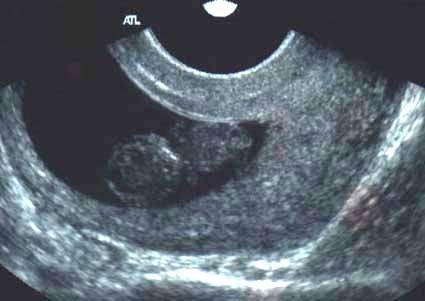 Pregnancy Ultrasound Picture : week 9